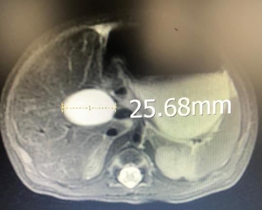 胆总管增大12mm,儿童胆总管多少算扩张