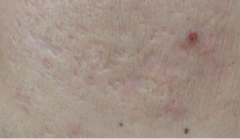 瘢痕体质留疤了怎么办,只有开刀才长疤是瘢痕体质吗