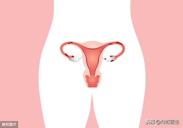 B超检查“子宫内膜回声不均”，我到底得了什么病？