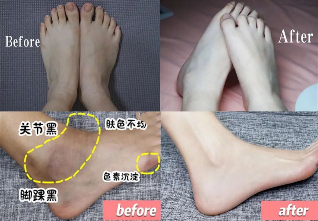 啤酒消痘痘,喝啤酒会消除痘痘吗