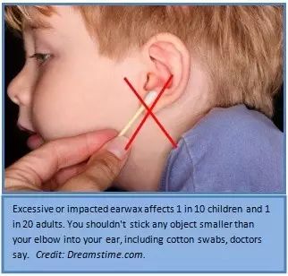 棉签抠耳朵导致癫痫,用棉签掏耳朵不小心被撞了一下