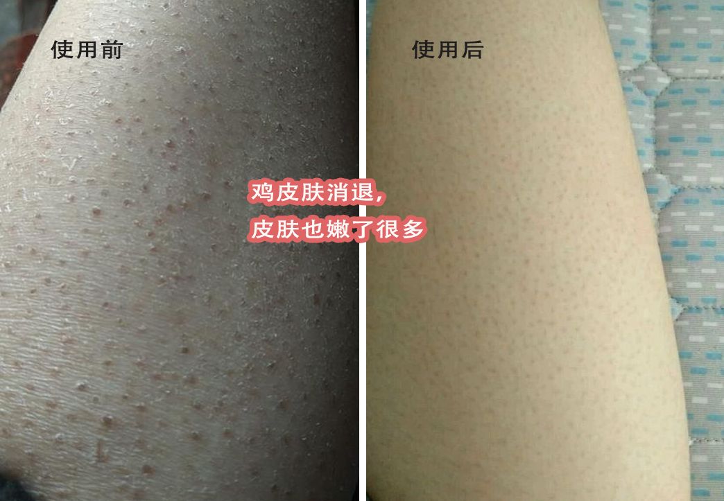 别放弃，烦人的“鸡皮疙瘩”，真的还可以再救一下