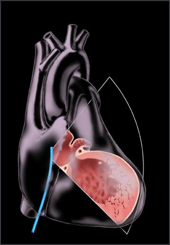 唐山心脏射频消融术哪里做的好,导管冷冻消融治疗房颤全过程