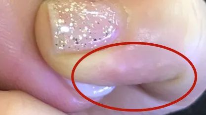 长痒痒的小水泡可以挤吗,小水泡很痒怎么快速止痒