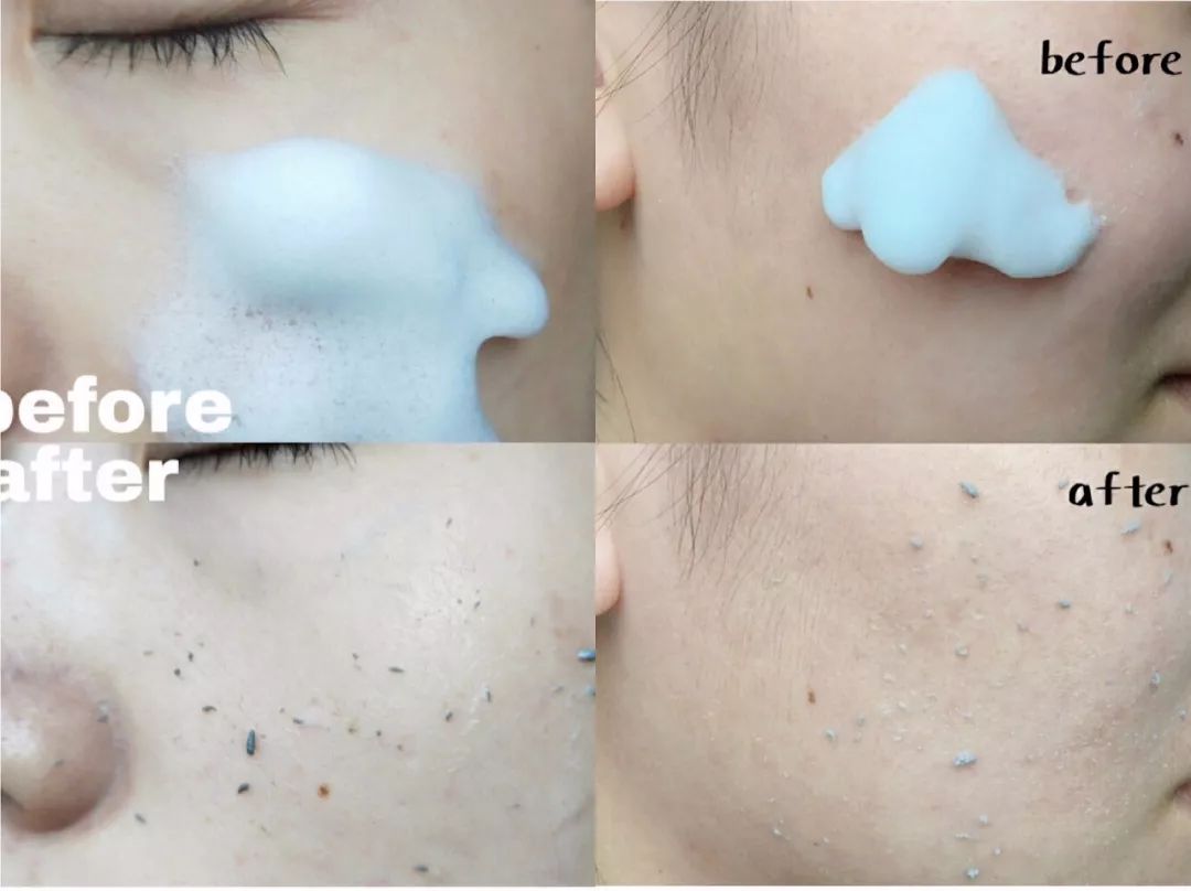 鼻头痘痘挤出来的白色物质是什么,团状红痘痘