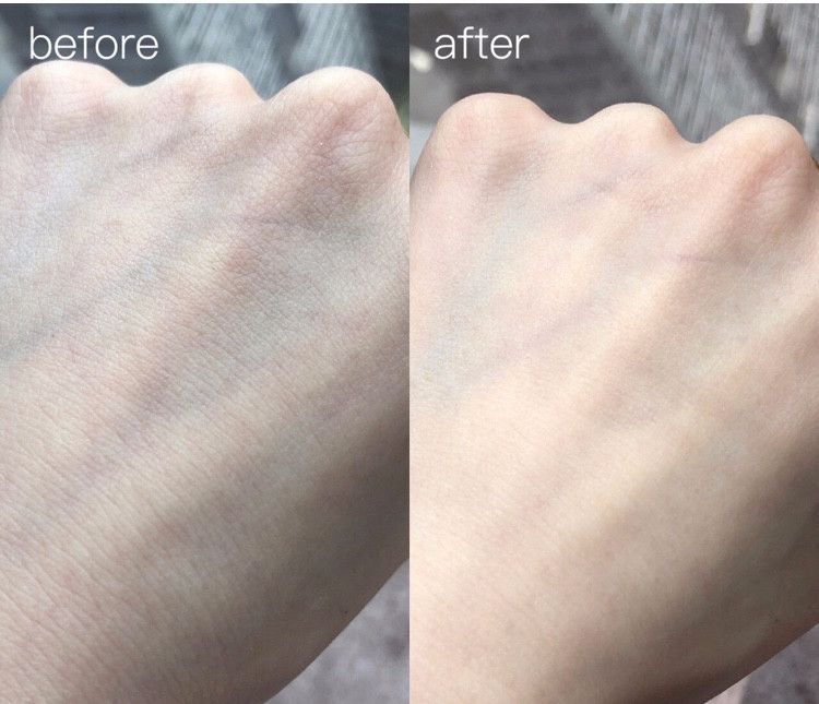 挤痘痘出来的白色长条状是什么,痘痘黑头挤出白颗粒