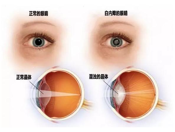 专病诊疗,眼科医院白内障门诊检查项目