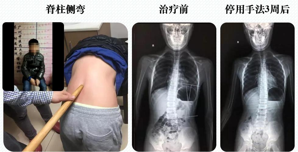 脊柱侧弯骨科治疗方法,筋骨堂正骨整脊理疗