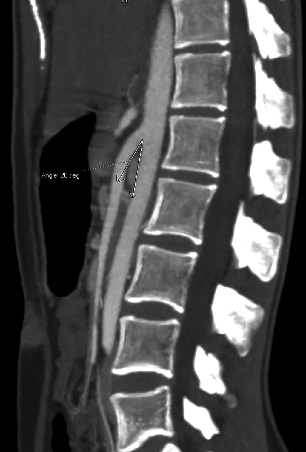 肠系膜上动脉综合征治疗,肠系膜上动脉综合征发生在哪