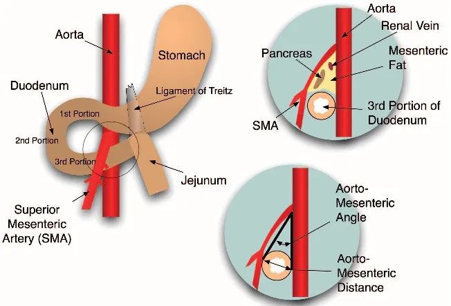 肠系膜上动脉综合征治疗,肠系膜上动脉综合征发生在哪