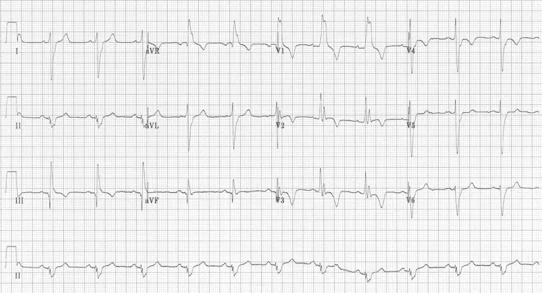 肺栓塞心电图表现是什么,肺栓塞的心电图改变