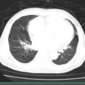 新冠肺炎引起冠心病,新冠医案