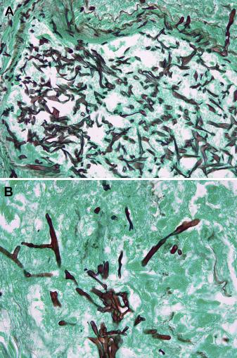 50多岁胸部有硬块疼痛是什么病,老人乳房有肿块胸腔痛