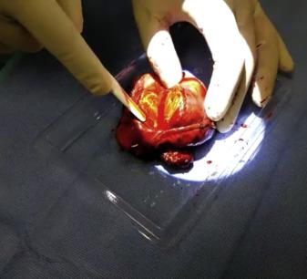 50多岁胸部有硬块疼痛是什么病,老人乳房有肿块胸腔痛