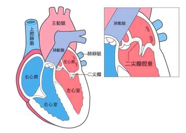 王清海名医工作室|三副中药+“双心”治疗，二尖瓣脱垂综合征老伯“不放支架”的心愿达成了