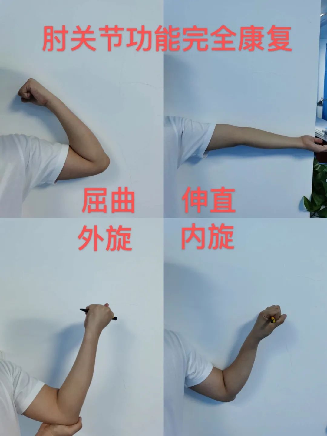 骨折受伤去医院正骨真实最新视频,西安中医正骨复位骨折