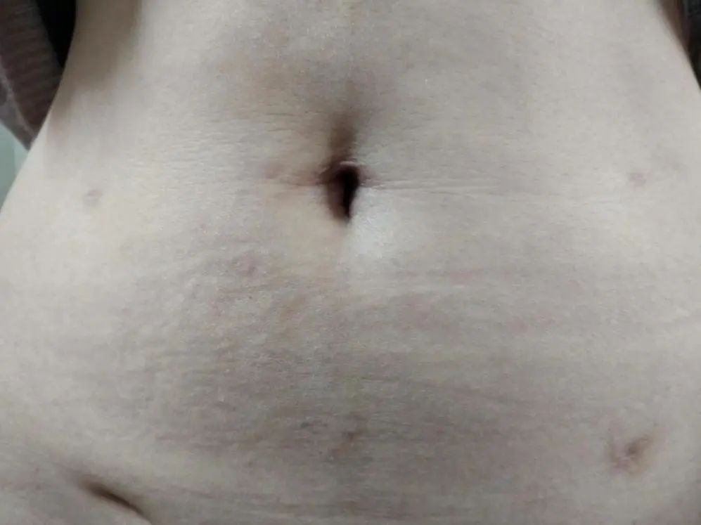 直肠癌扩散还有必要做手术么,直肠癌已经不能动手术了能活多久