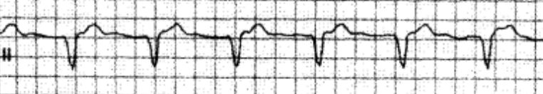 室速全名叫什么,室速的解读和识别