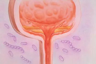 腺性膀胱炎和一般膀胱炎的区别,间质性膀胱炎与特发性膀胱炎