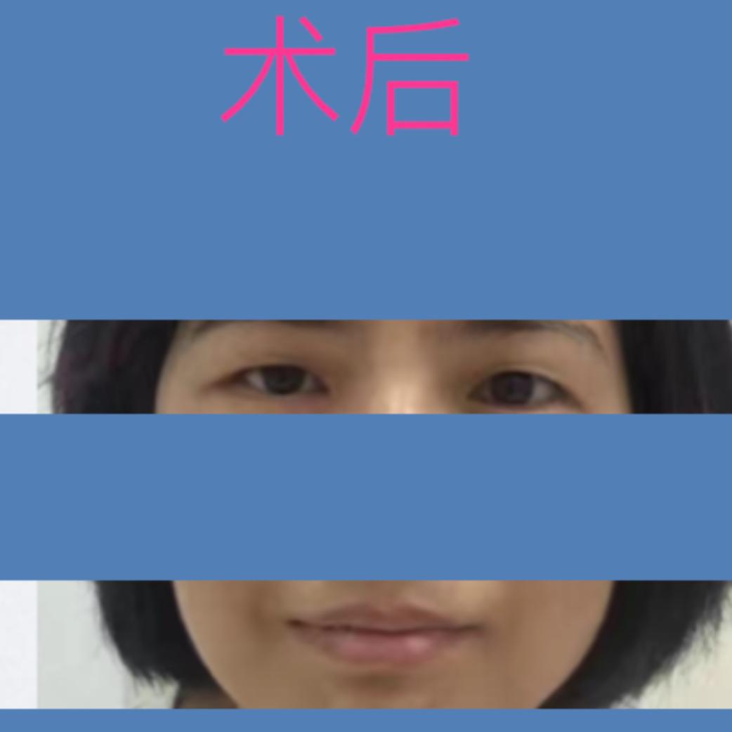 四川华西医院治疗面瘫怎么样,面瘫其实很难治愈