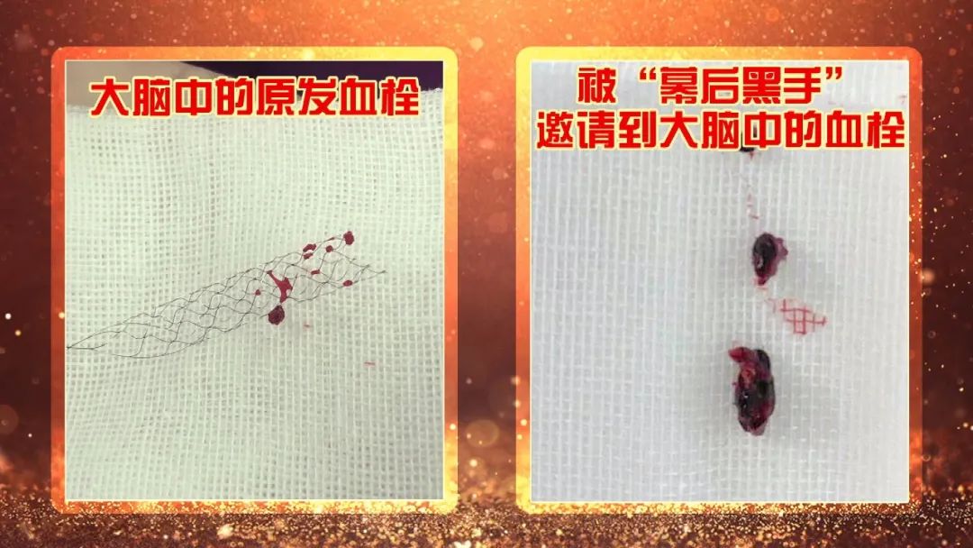 养生堂警惕致命的假脑梗完整版,北京卫视养生堂国医大师预防脑梗