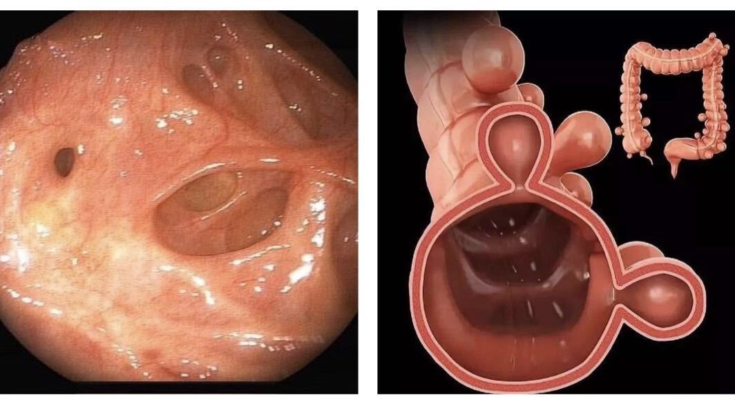 肠子蠕动左下腹隐痛警惕肠癌,肠癌患者健康科普视频