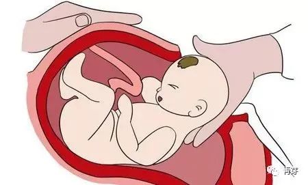 自然分娩VS剖宫产——准妈妈要科学选择