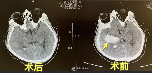 清华长庚神经外科手术,宣武医院治疗脑出血擅长