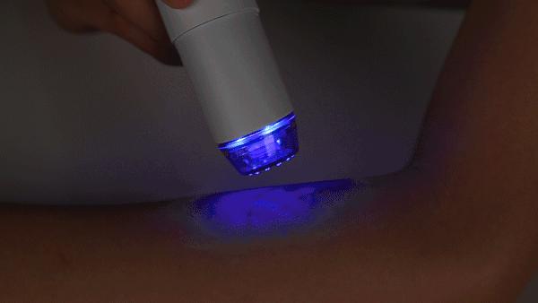 痘痘挤出的白米粒是什么,痘痘挤出来的白色乳浆是什么