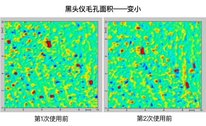 痘痘挤出的白米粒是什么,痘痘挤出来的白色乳浆是什么