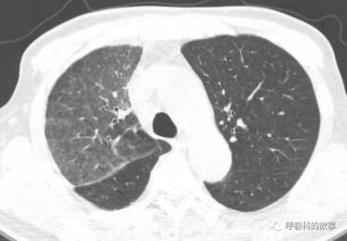 我是如何诊治肺炎的？（4）——如何理解抓住关键信息（2）