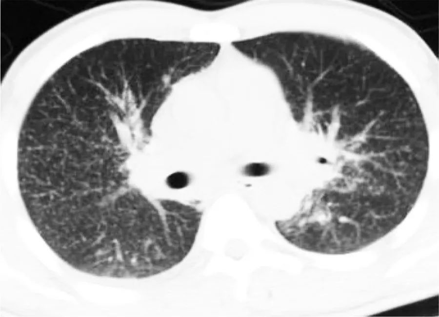 粟粒状肺结核肺部ct表现,粟粒型肺结核ct图