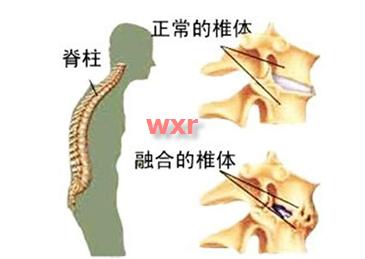 35岁男性患有强直性脊柱炎,老人腰直不起来是强直性脊柱炎