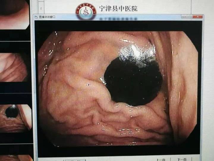 吉林一男子吃饺子误将硬币吞进肚,吃饺子吃到硬币把牙崩掉了一块