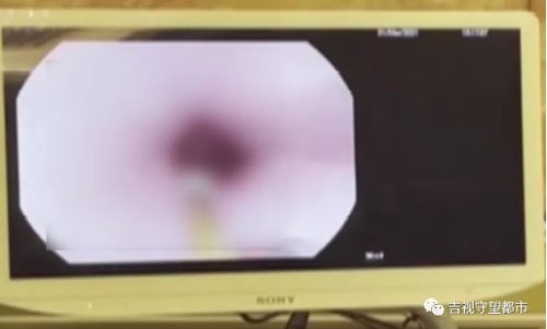 误吞4厘米钢钉，13岁“熊孩子”被紧急送医