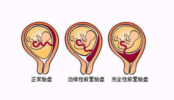 孕妈妈与龙凤胎宝宝性命攸关，怀化市二医院多学科联动救治