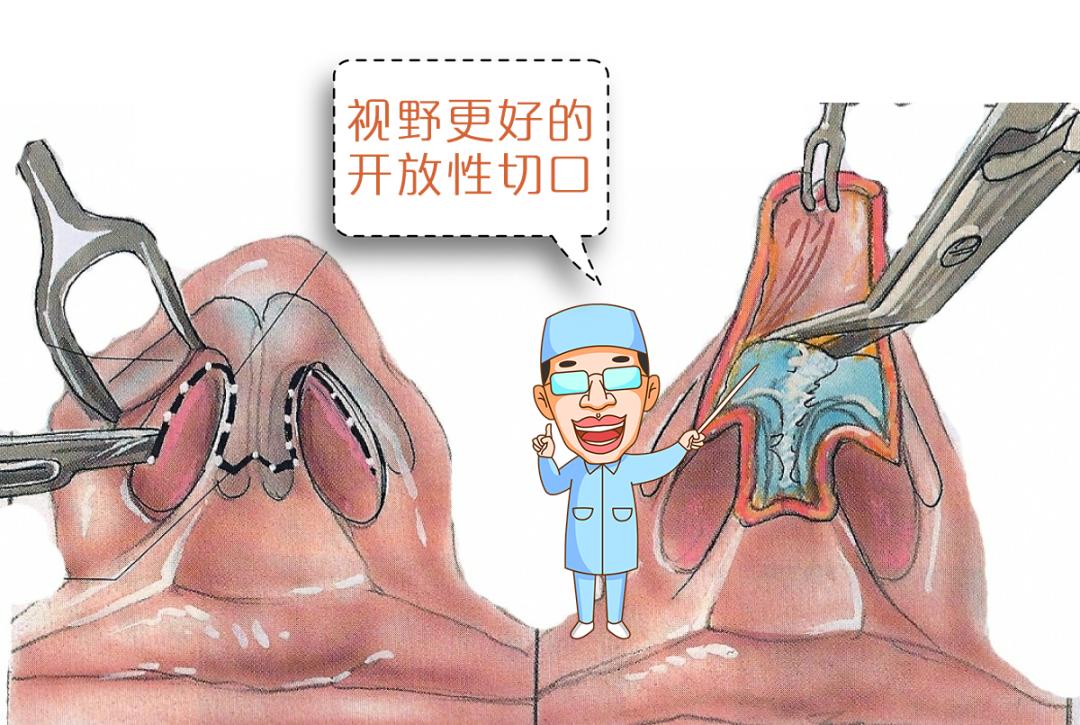 鼻综合整形切口,鼻综合切口处愈合几率