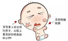 又痒又痛的红色疹子,又长湿疹又长荨麻疹怎么办