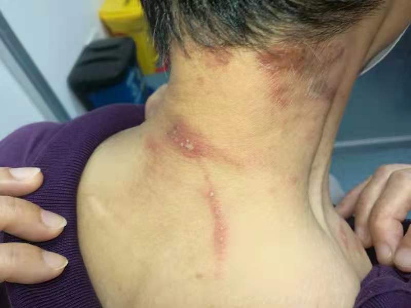 隐翅虫主要分布广东,罕见大量隐翅虫入侵