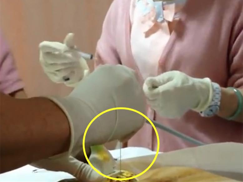 让孕妈颤抖的羊水穿刺,到底是怎么做的?光看图片都觉得疼