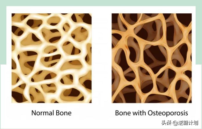 50岁女性如何补钙对抗骨质疏松,骨质疏松什么程度才可以打补钙针