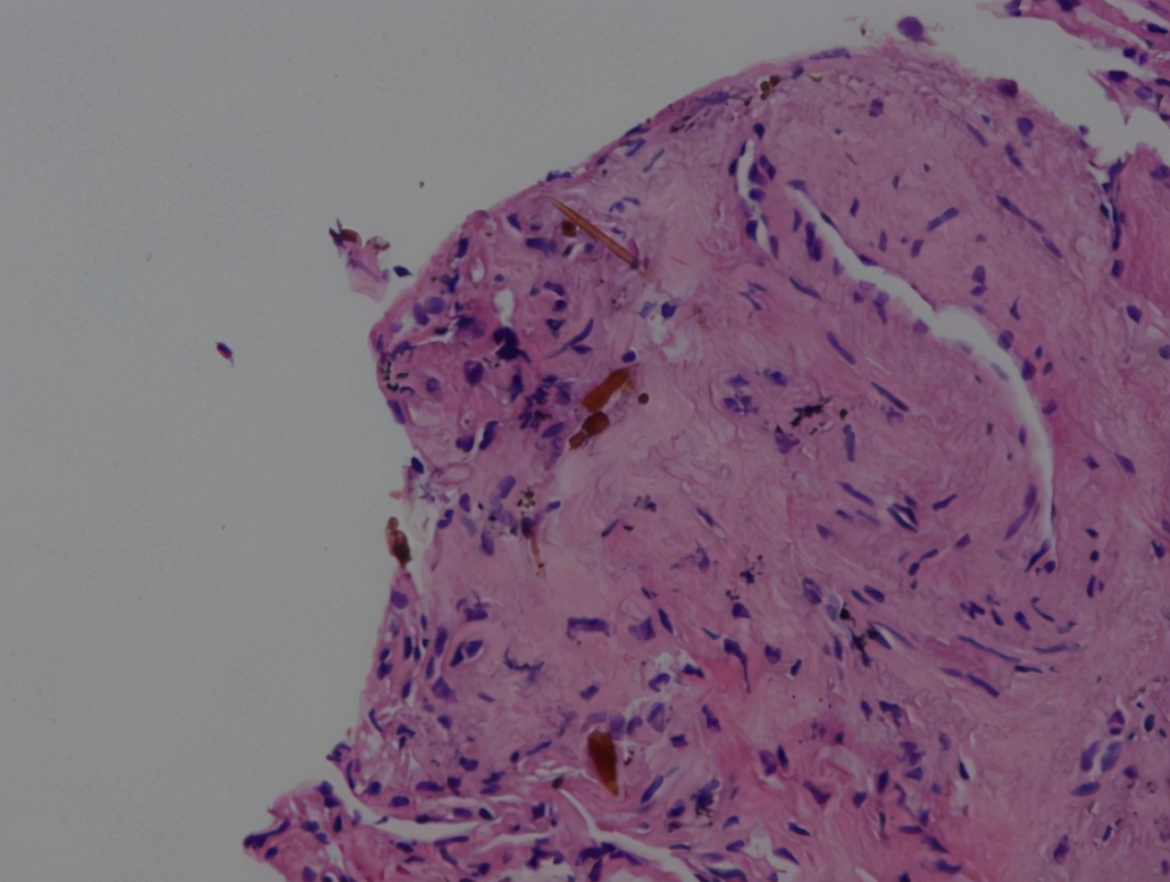 56岁男性发现双肺,56岁男性发现双肺数百个结节
