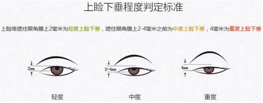 双眼皮宽深修复后三眼皮案例,埋线双眼皮过宽如何修复