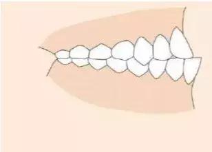 你需要去做个牙齿矫正是什么意思,为什么要做牙齿正畸