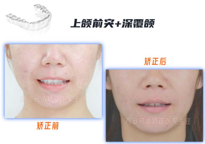 牙齿矫正雁塔区,矫正牙齿拔掉4颗智齿