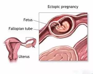早孕期血清学筛查准确率,早孕期查哪些指标比较准确