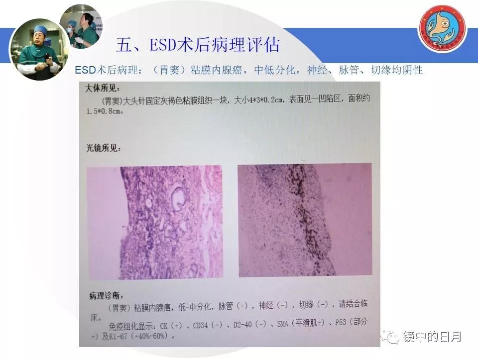 低分化胃癌早期时候做内镜手术吗,早期胃癌内镜手术后追加外科手术