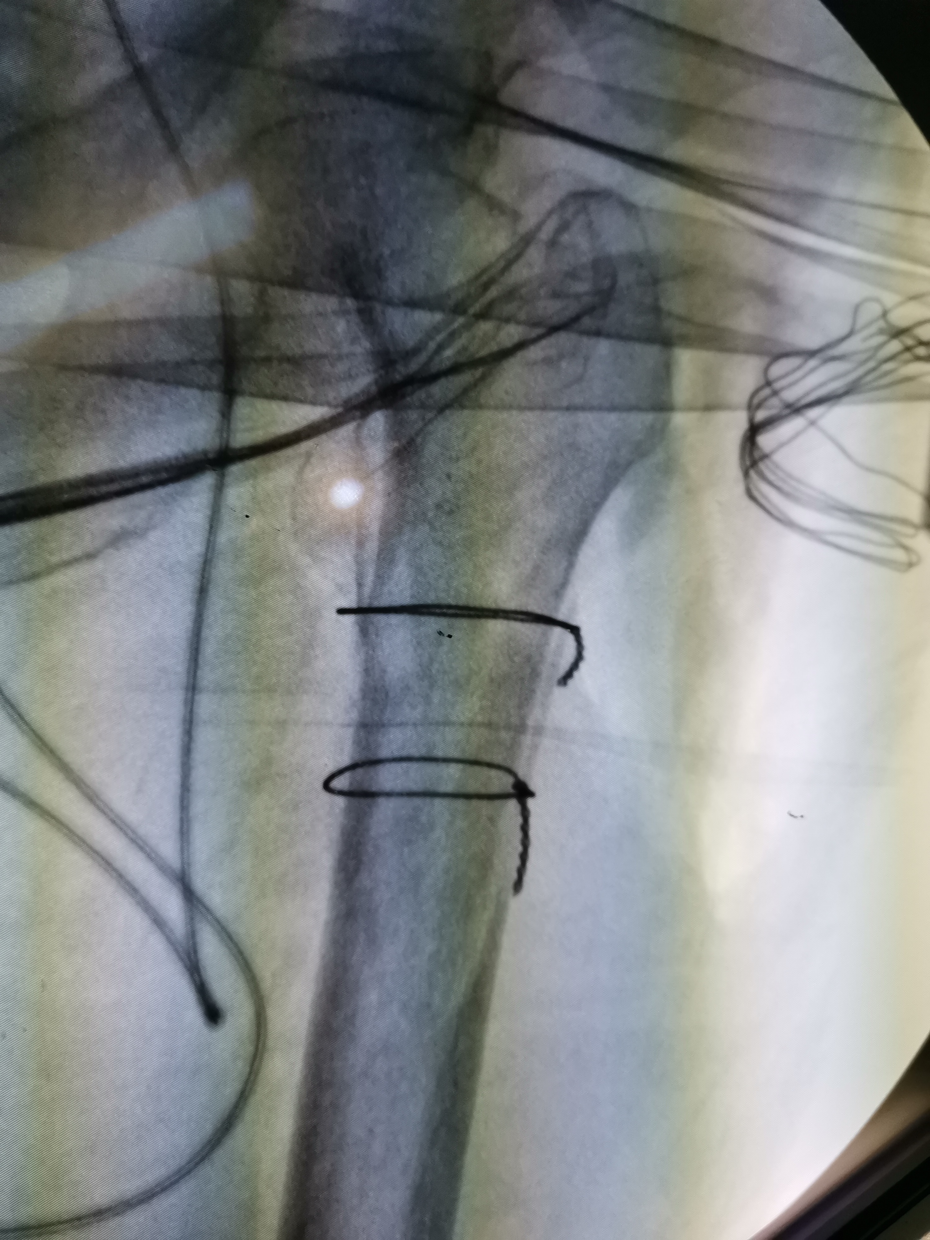 老人一屁股摔倒脊柱骨折如何治疗,老人一屁股坐地上怎么处理