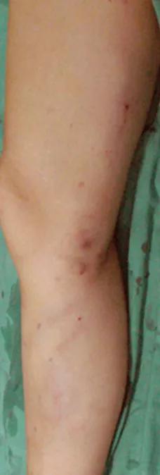 腿上长蚯蚓有哪些东西要戒掉,腿上有小蚯蚓怎么办