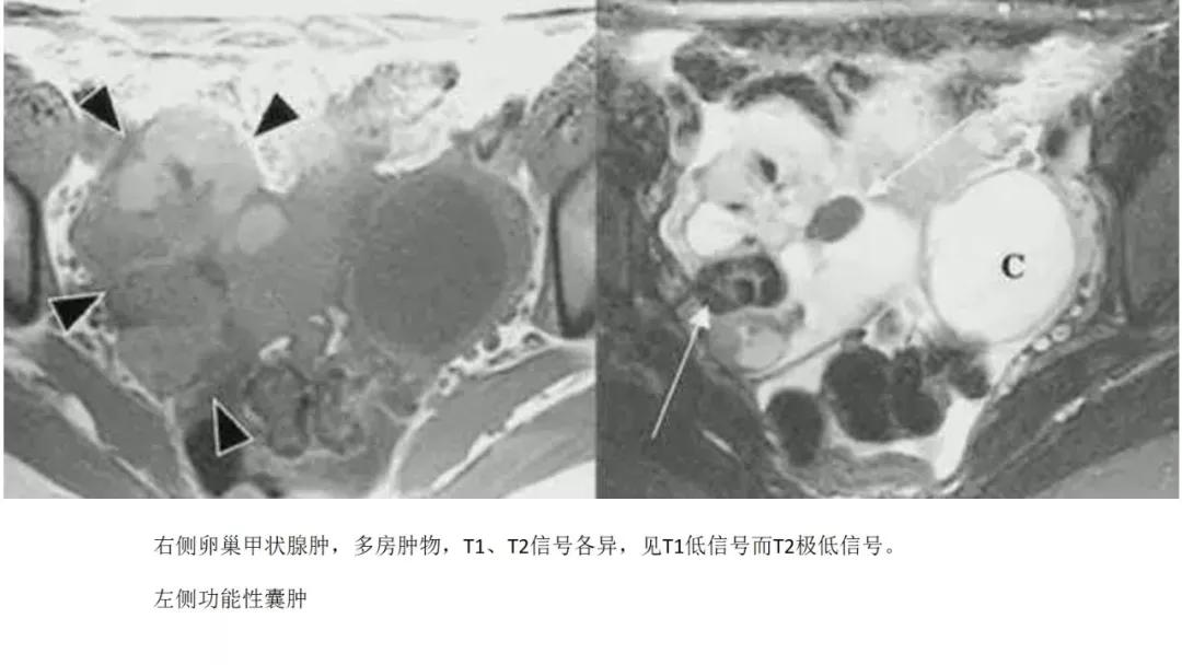 卵巢原发肿瘤的分析思路